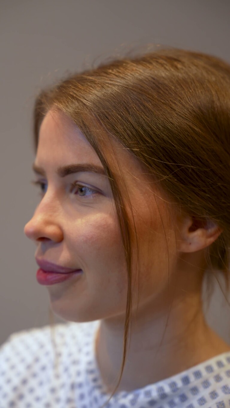 Aesthetify – Junge Patientin im Profil vor der Behandlung